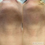 Beauty by Buket Diodenlaser Dauerhafte Haarentfernung Mannheim