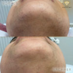 Beauty by Buket Diodenlaser Dauerhafte Haarentfernung Mannheim