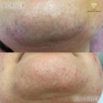 Beauty by Buket Diodenlaser Dauerhafte Haarentfernung Mannheim