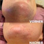 Beauty by Buket Diodenlaser Dauerhafte Haarentfernung Mannheim