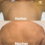 Beauty by Buket Diodenlaser Dauerhafte Haarentfernung Mannheim