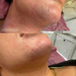 Beauty by Buket Diodenlaser Dauerhafte Haarentfernung Mannheim