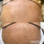 Beauty by Buket Microneedling Mannheim